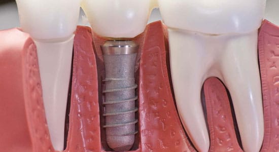 implantes-dentarios