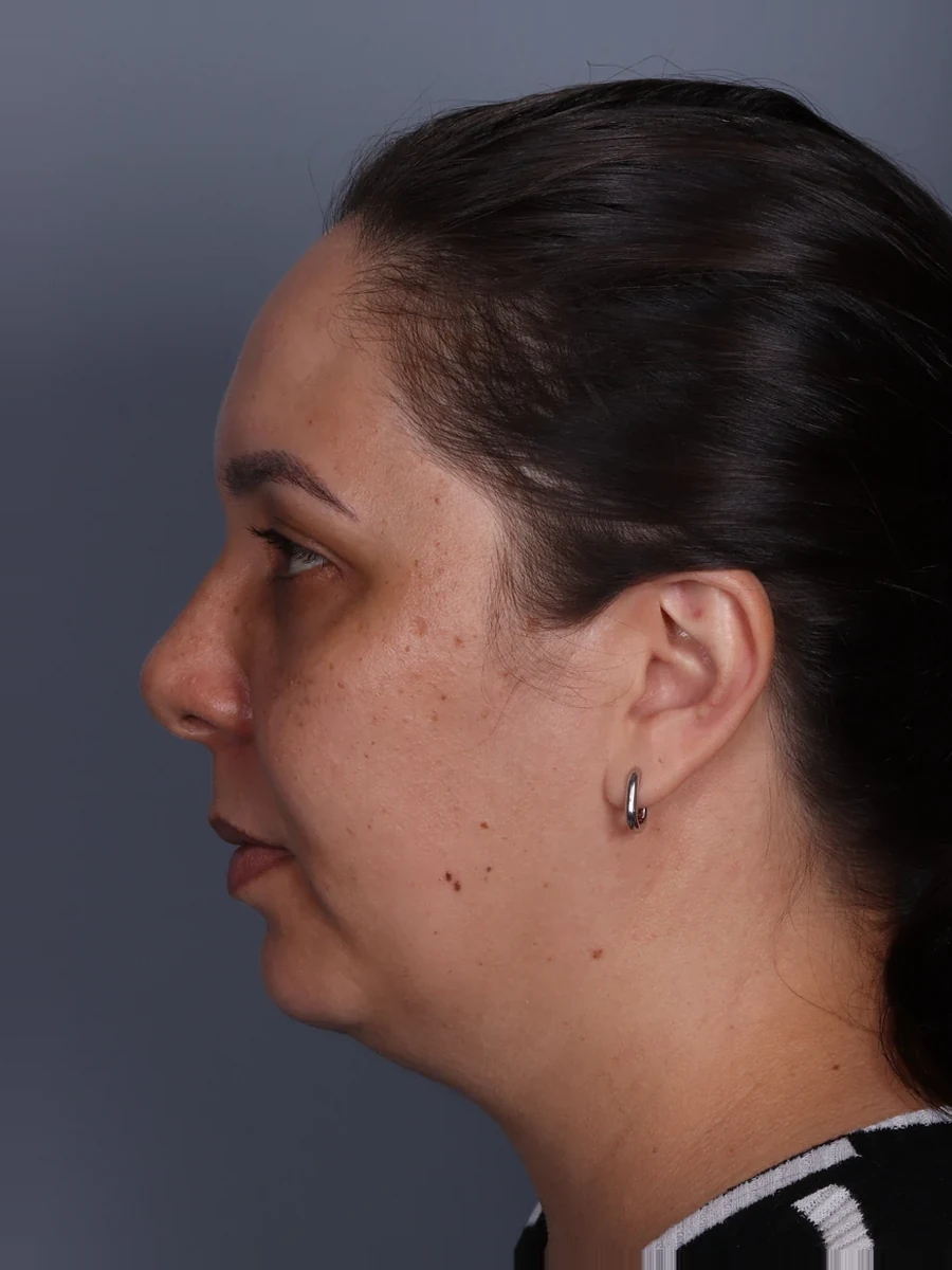Antes: cervicoplastia associada a mentoplastia