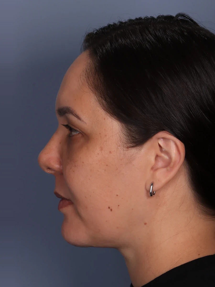 Depois: cervicoplastia associada a mentoplastia
