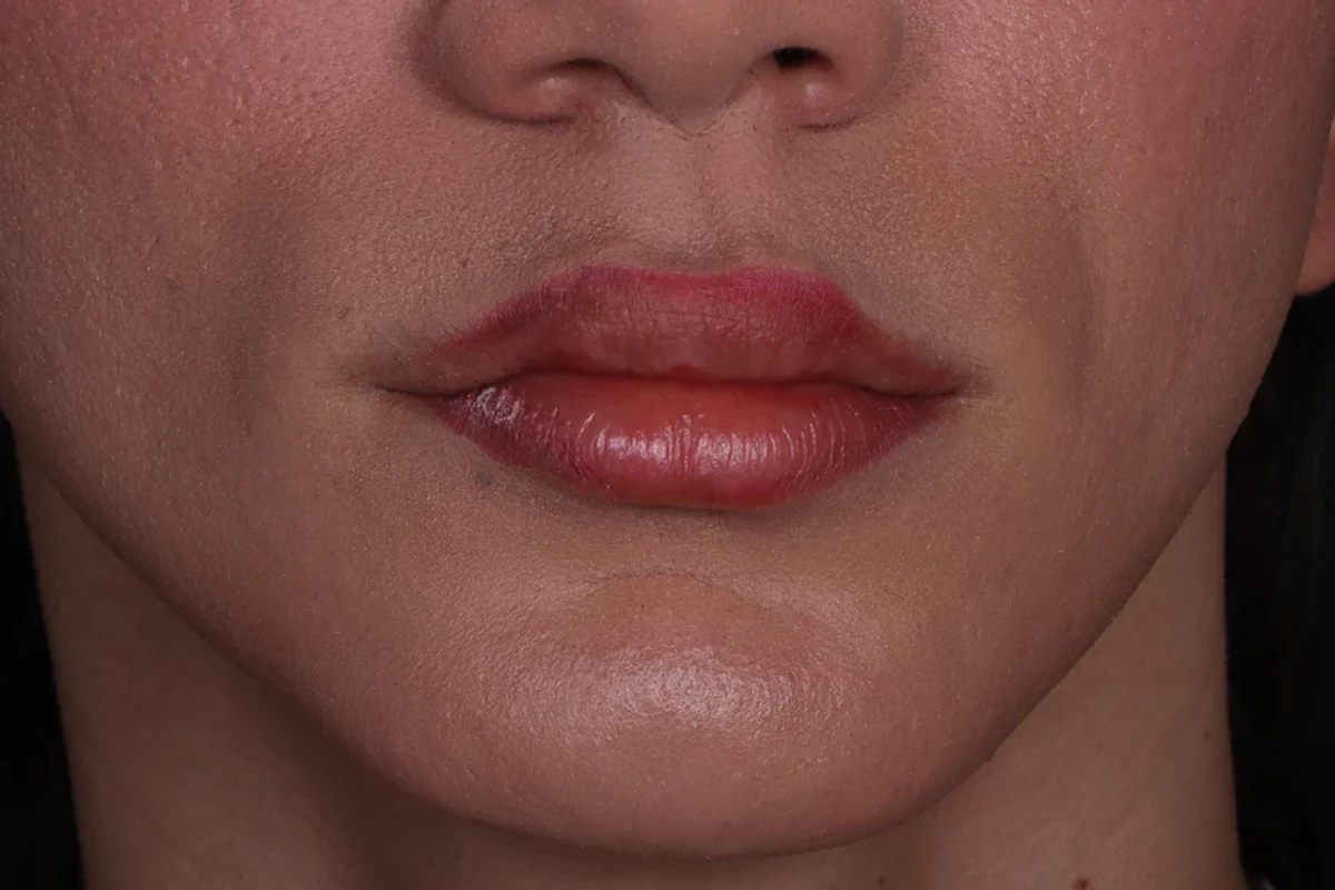 Antes: contorno mandibular