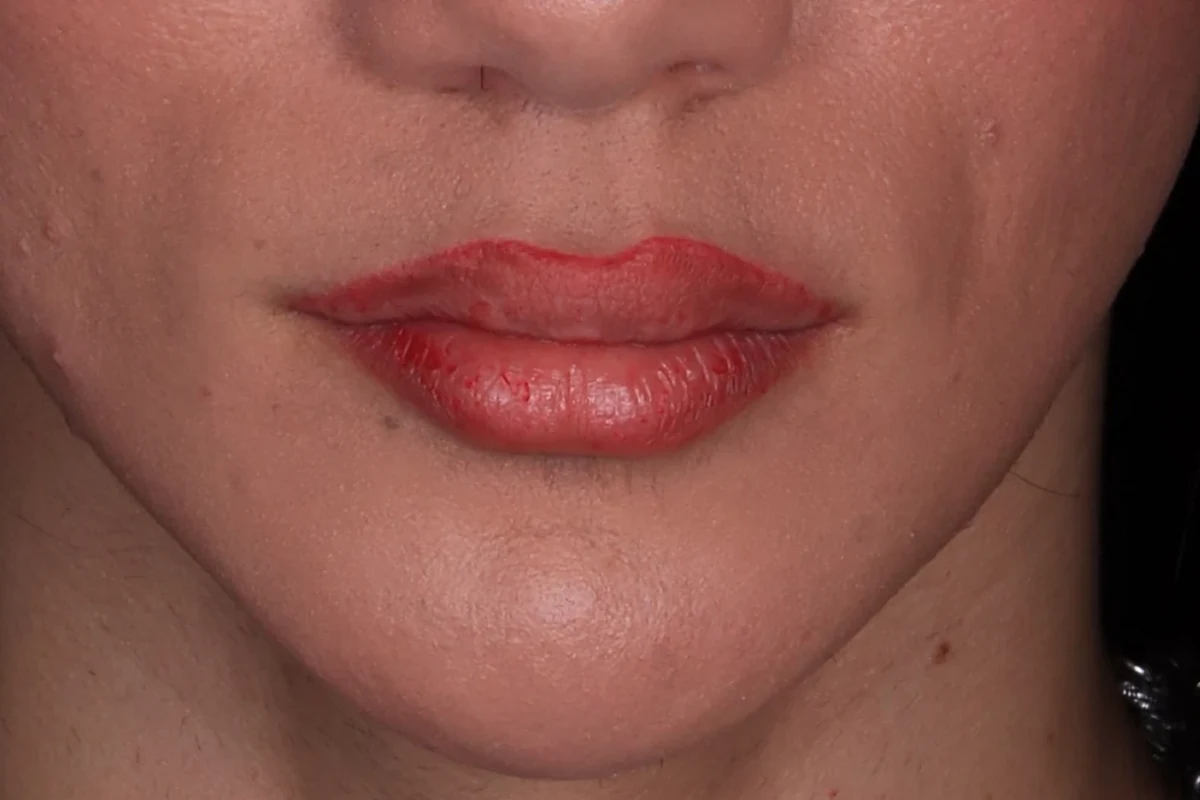 Depois: contorno mandibular