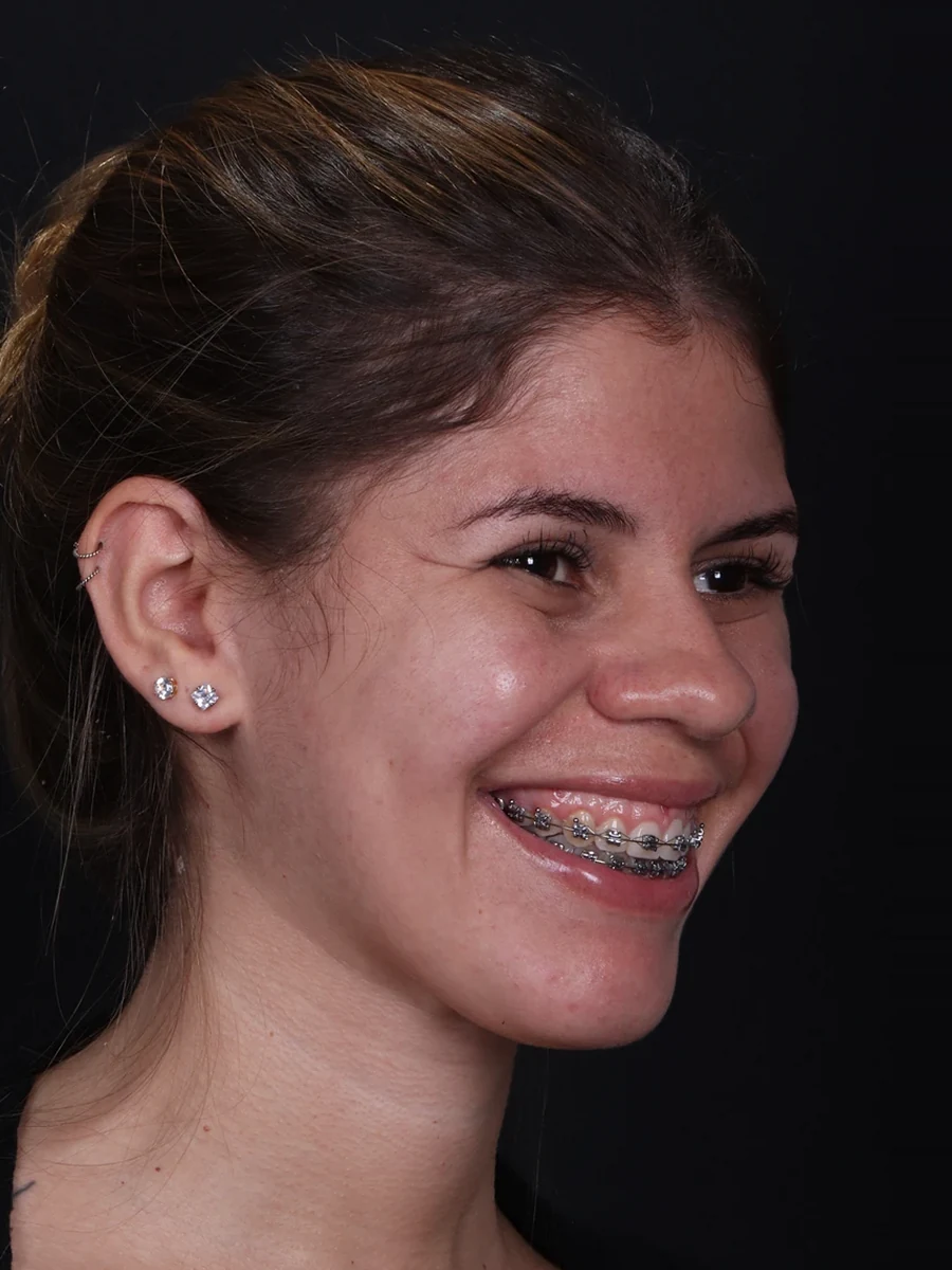 Antes: reoperação de cirurgia ortognática