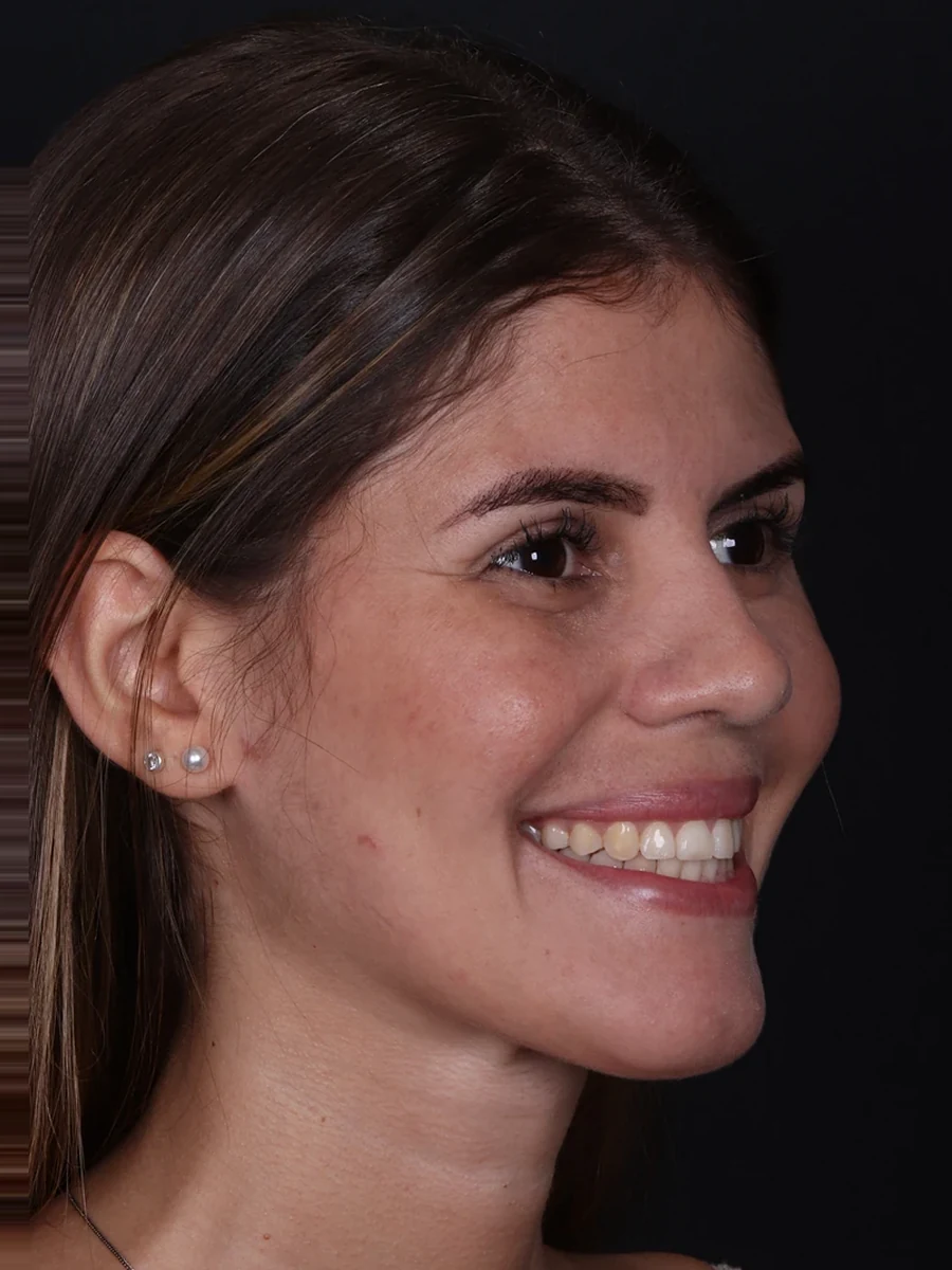 Depois: reoperação de cirurgia ortognática